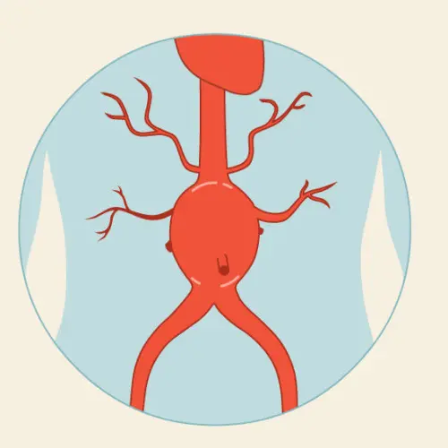 Aνεύρυσμα Κοιλιακής Αορτής | Παπουτσής Ιωακείμ Αγγειοχειρουργός - Στρατιωτικός Ιατρός Θεσσαλονίκη