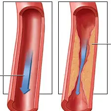 Στένωση Καρωτίδων | Παπουτσής Ιωακείμ Αγγειοχειρουργός - Στρατιωτικός Ιατρός Θεσσαλονίκη