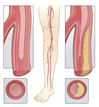 Στένωση & Απόφραξη Αρτηριών των Άκρων-Διαλείπουσα Χωλότητα | Παπουτσής Ιωακείμ Αγγειοχειρουργός - Στρατιωτικός Ιατρός Θεσσαλονίκη